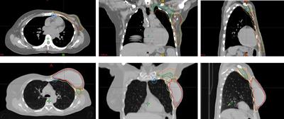 Evaluation of Ethos intelligent optimization engine for left locally advanced breast cancer